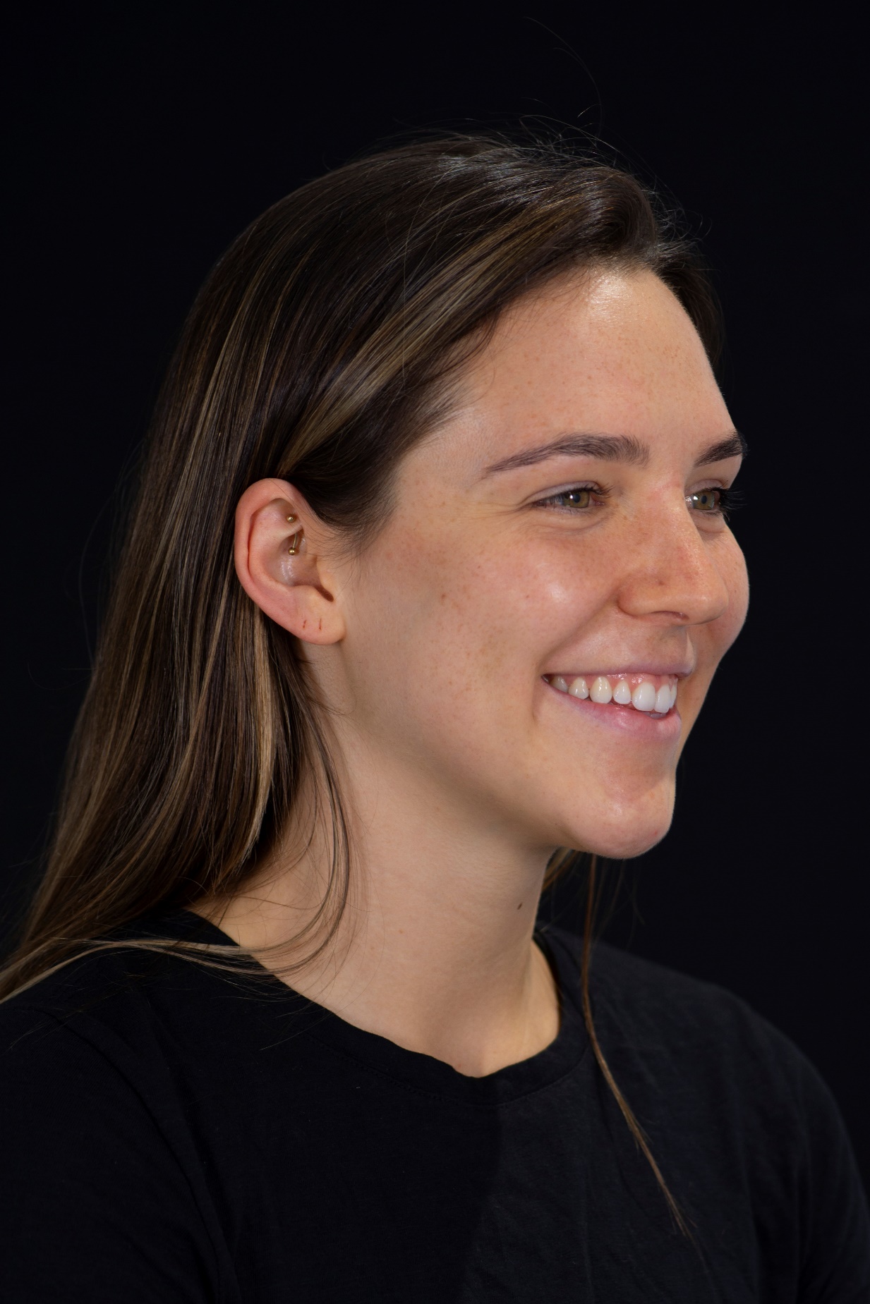 Before — Left Profile