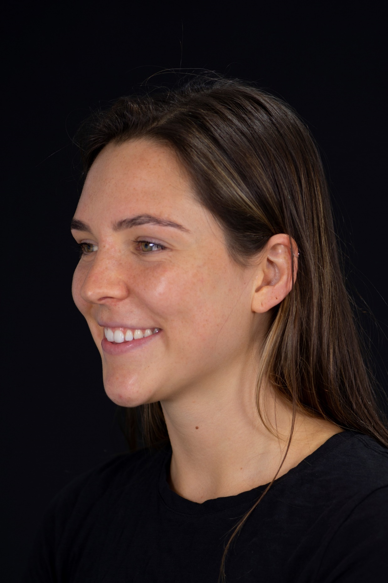 Before — Right Profile