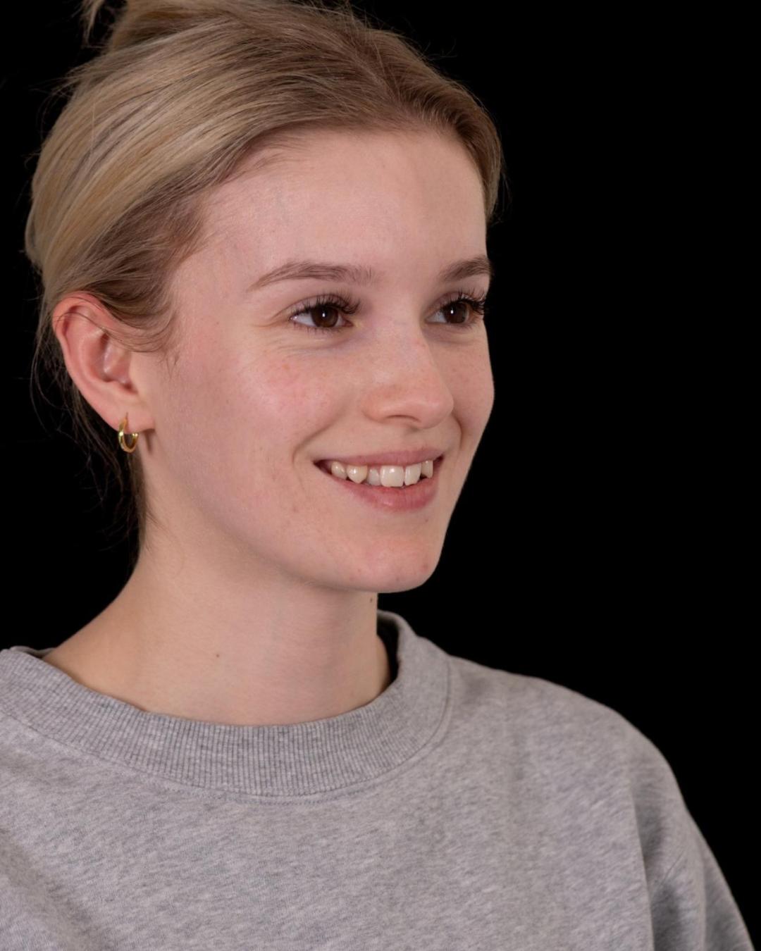 Before — Left Profile