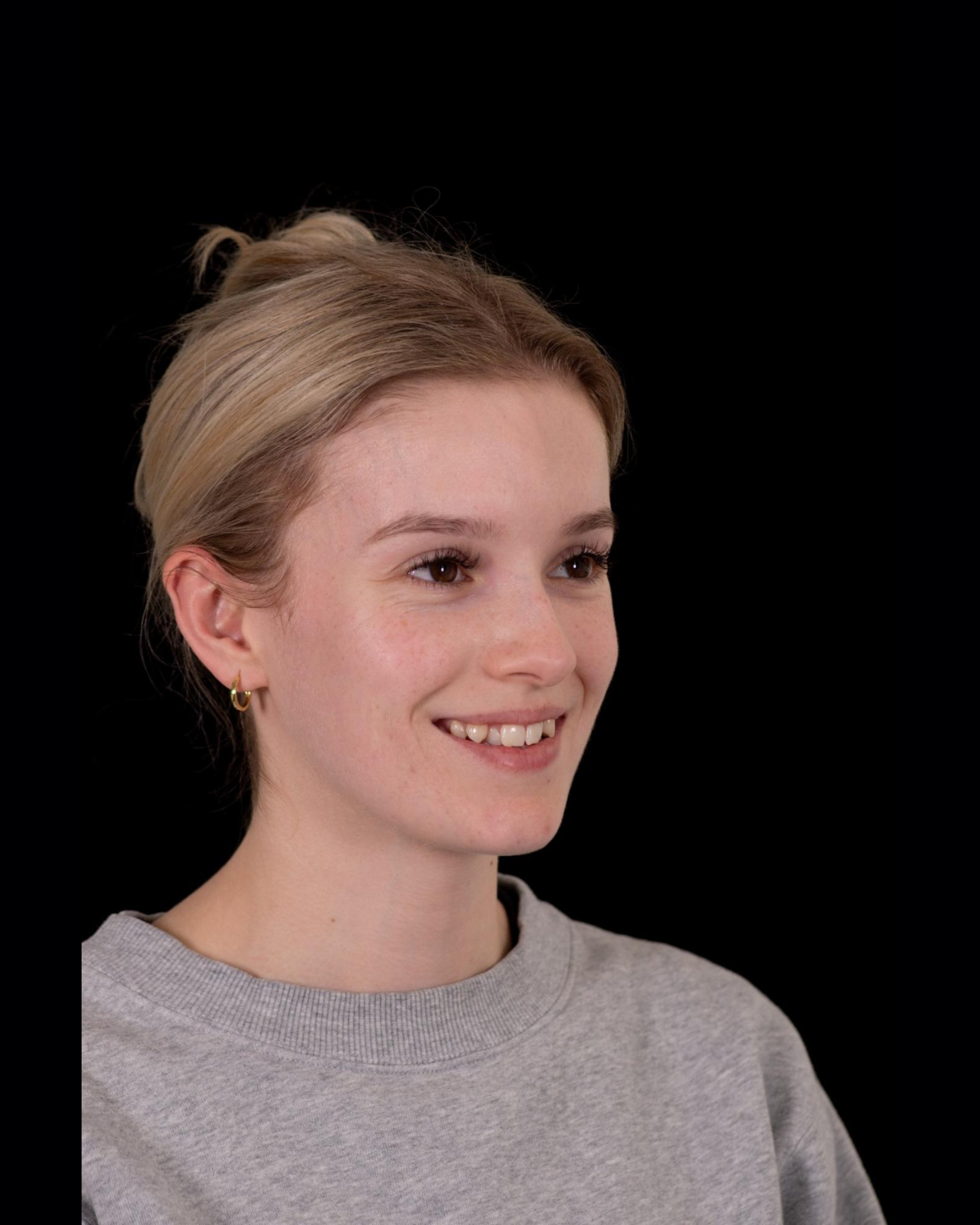 Before — Left Profile