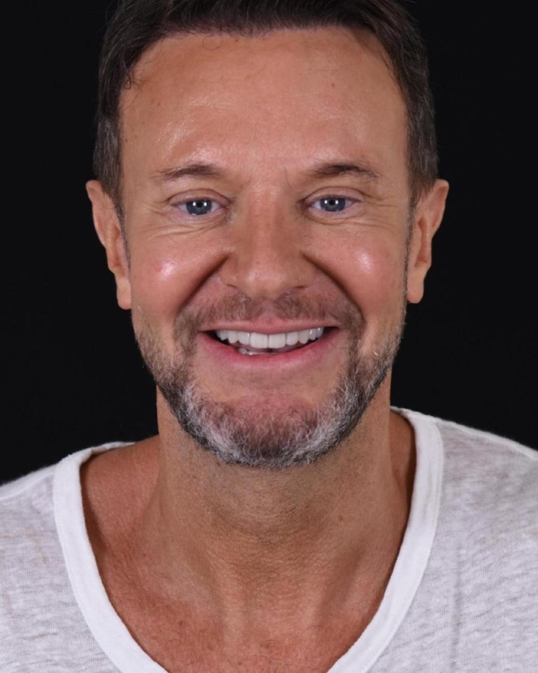 After — Front View