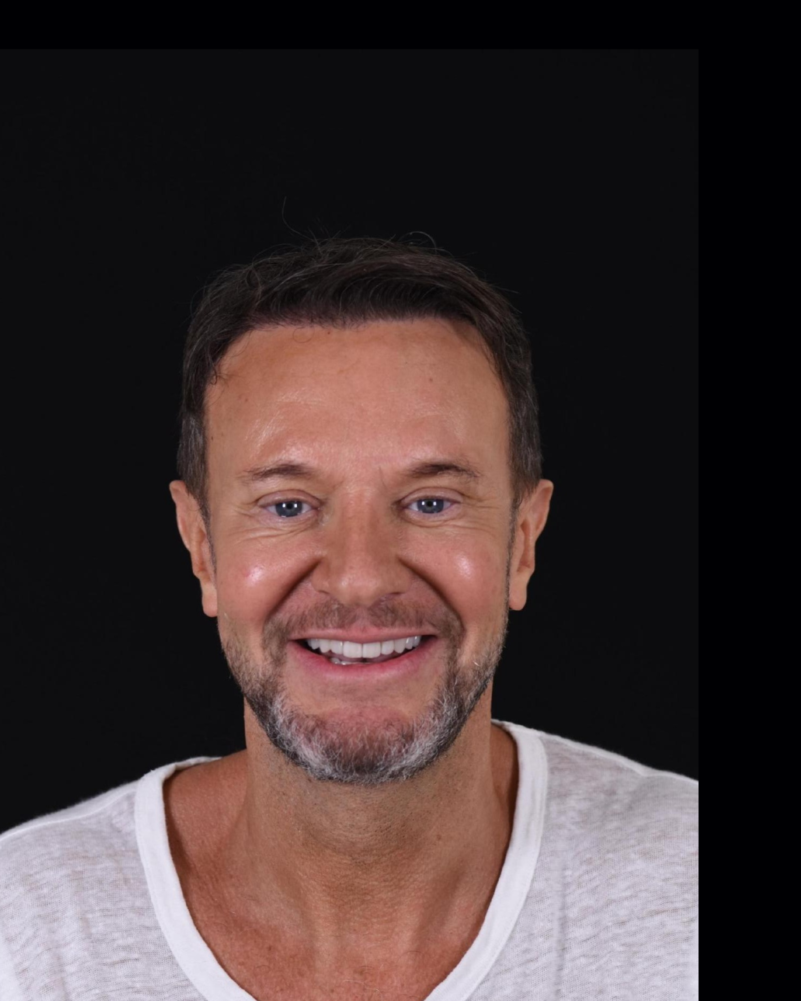 After — Front View