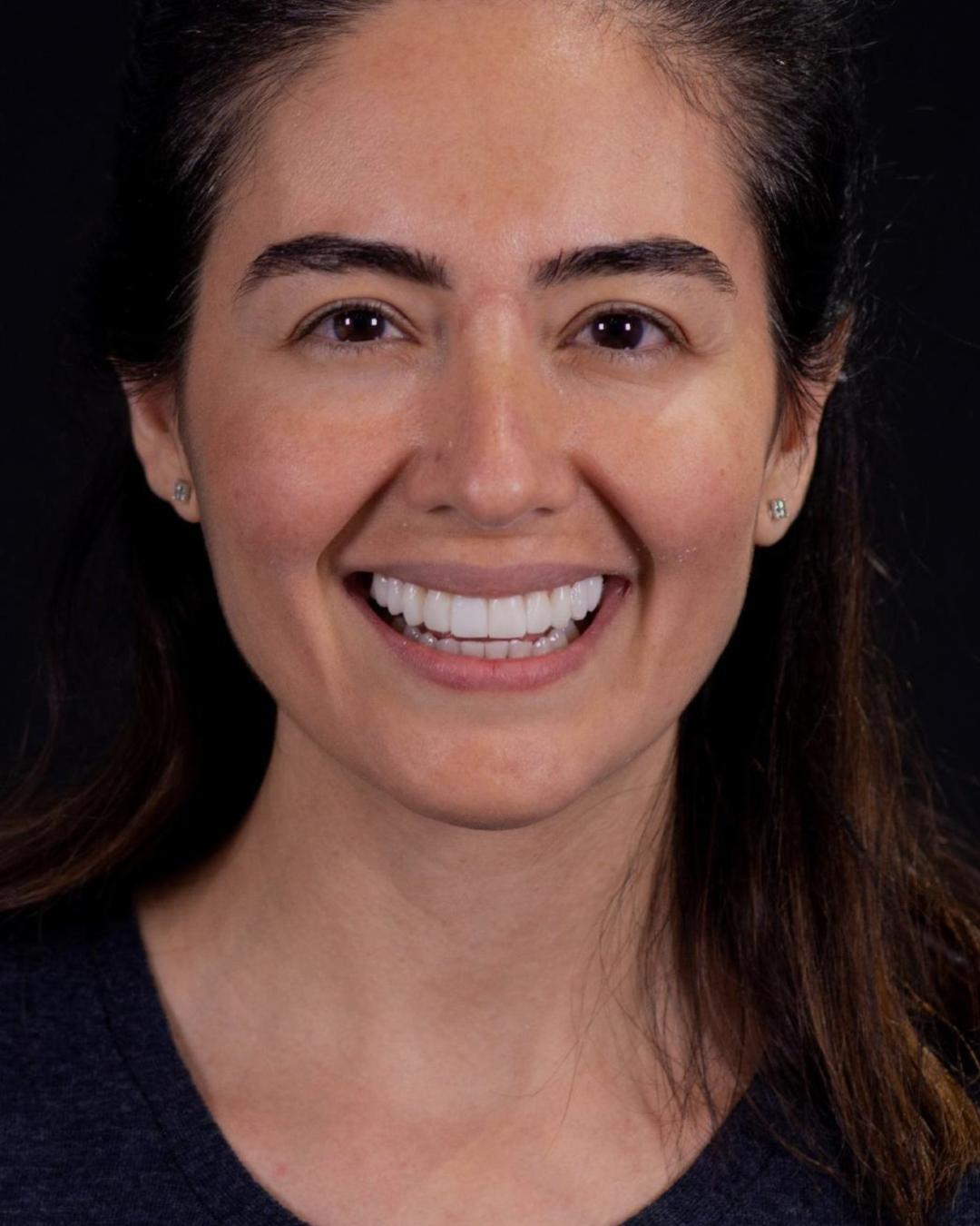 After — Front View