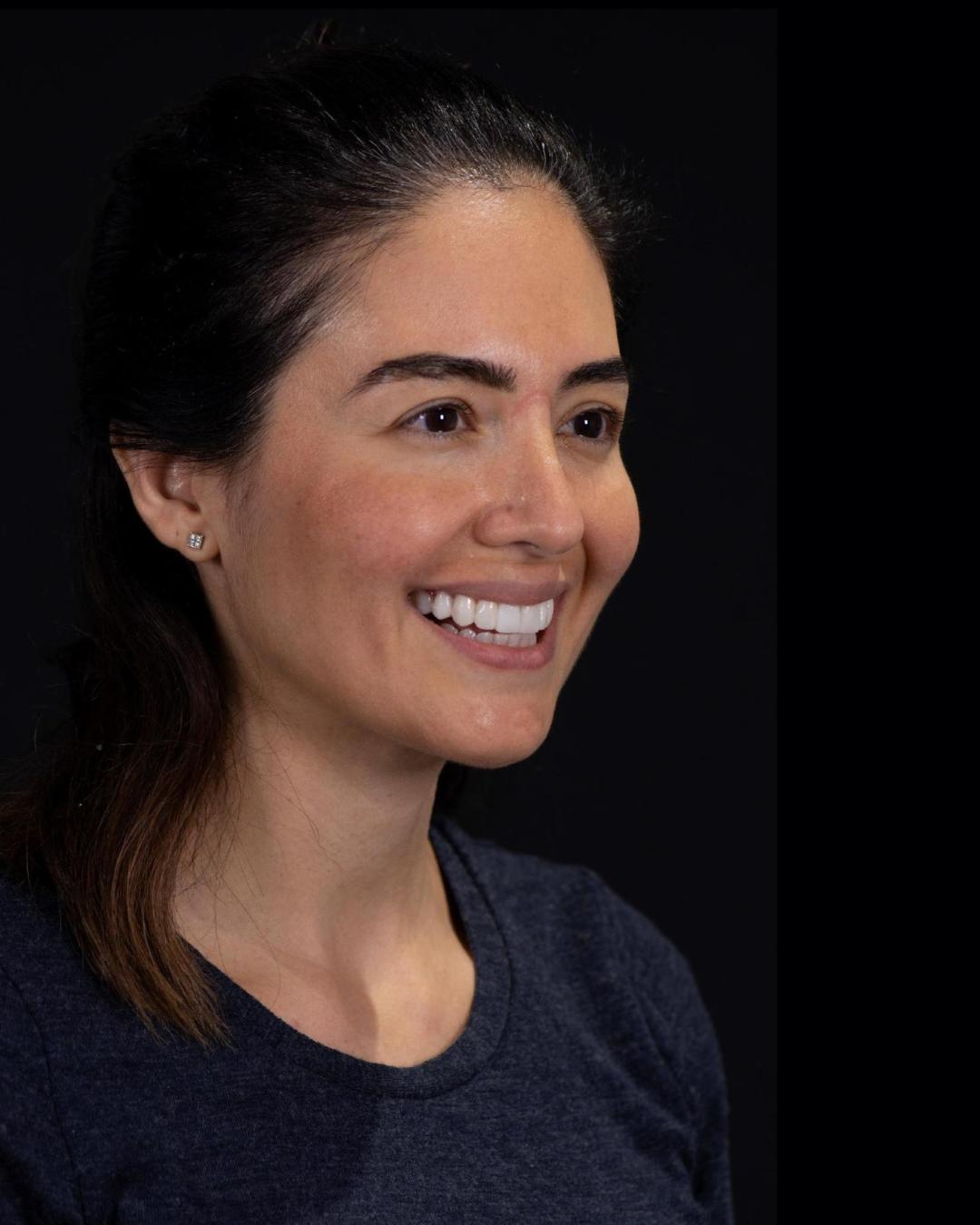 After — Left Profile