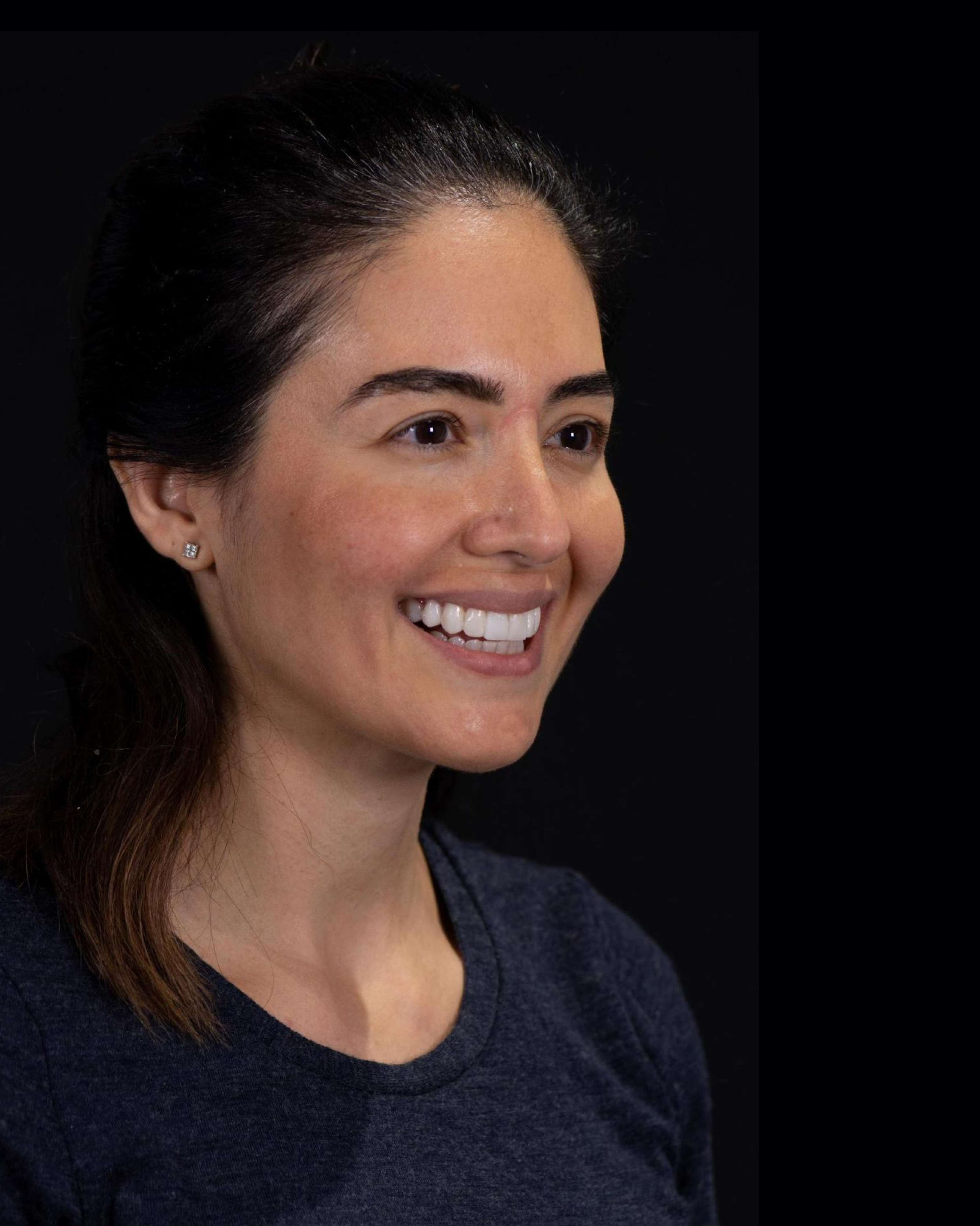 After — Left Profile