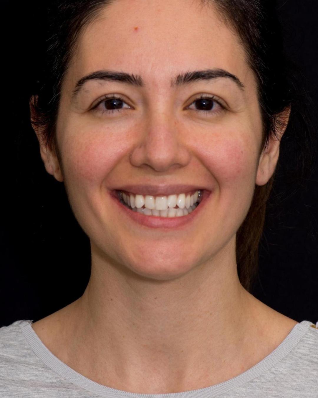 Before — Front View