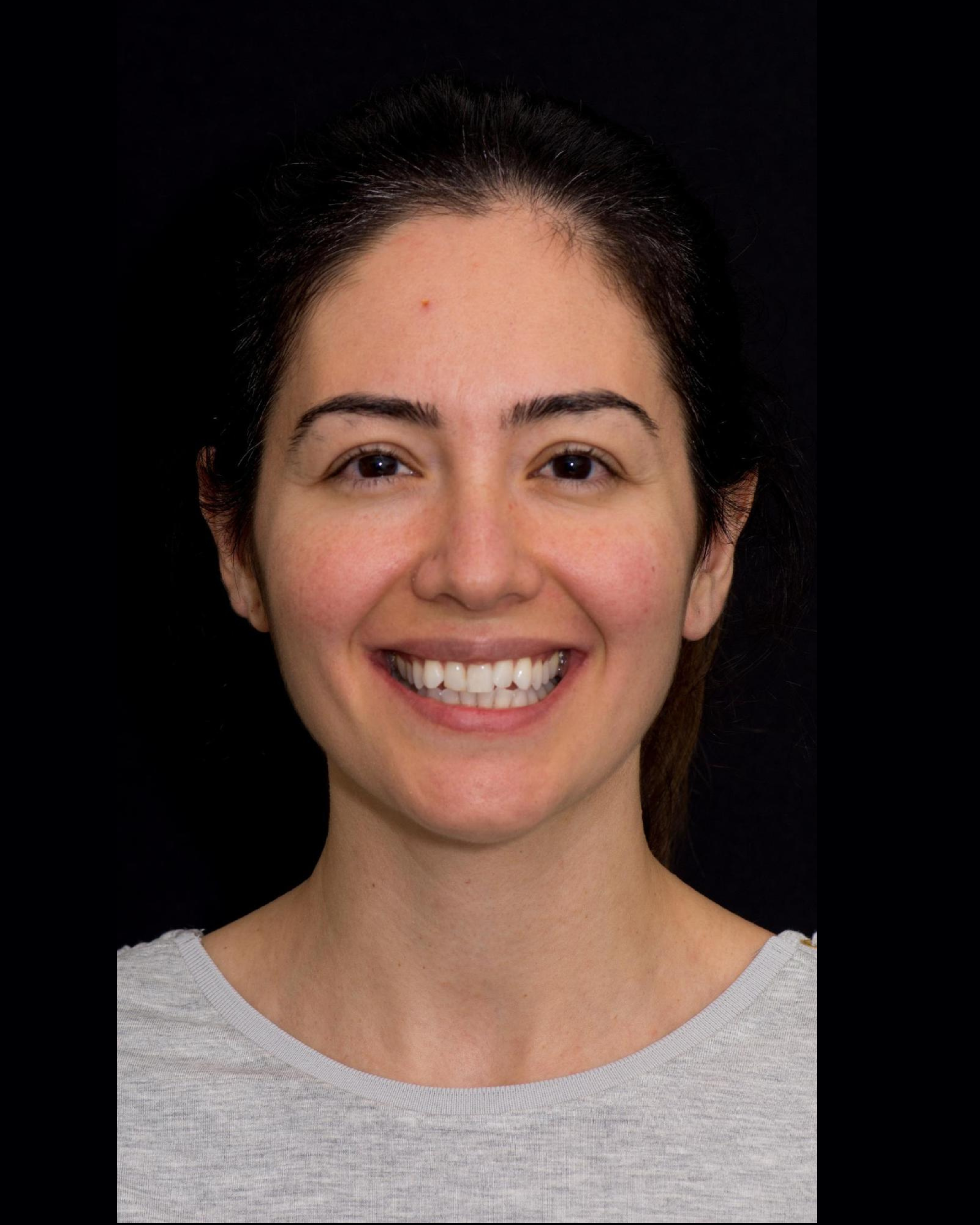 Before — Front View