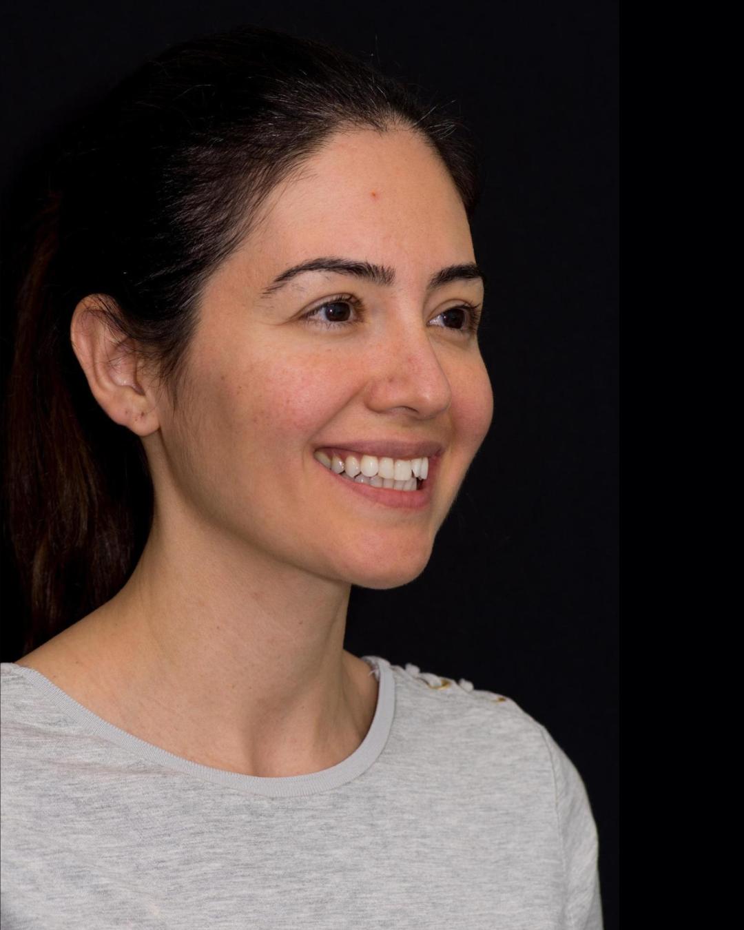 Before — Left Profile