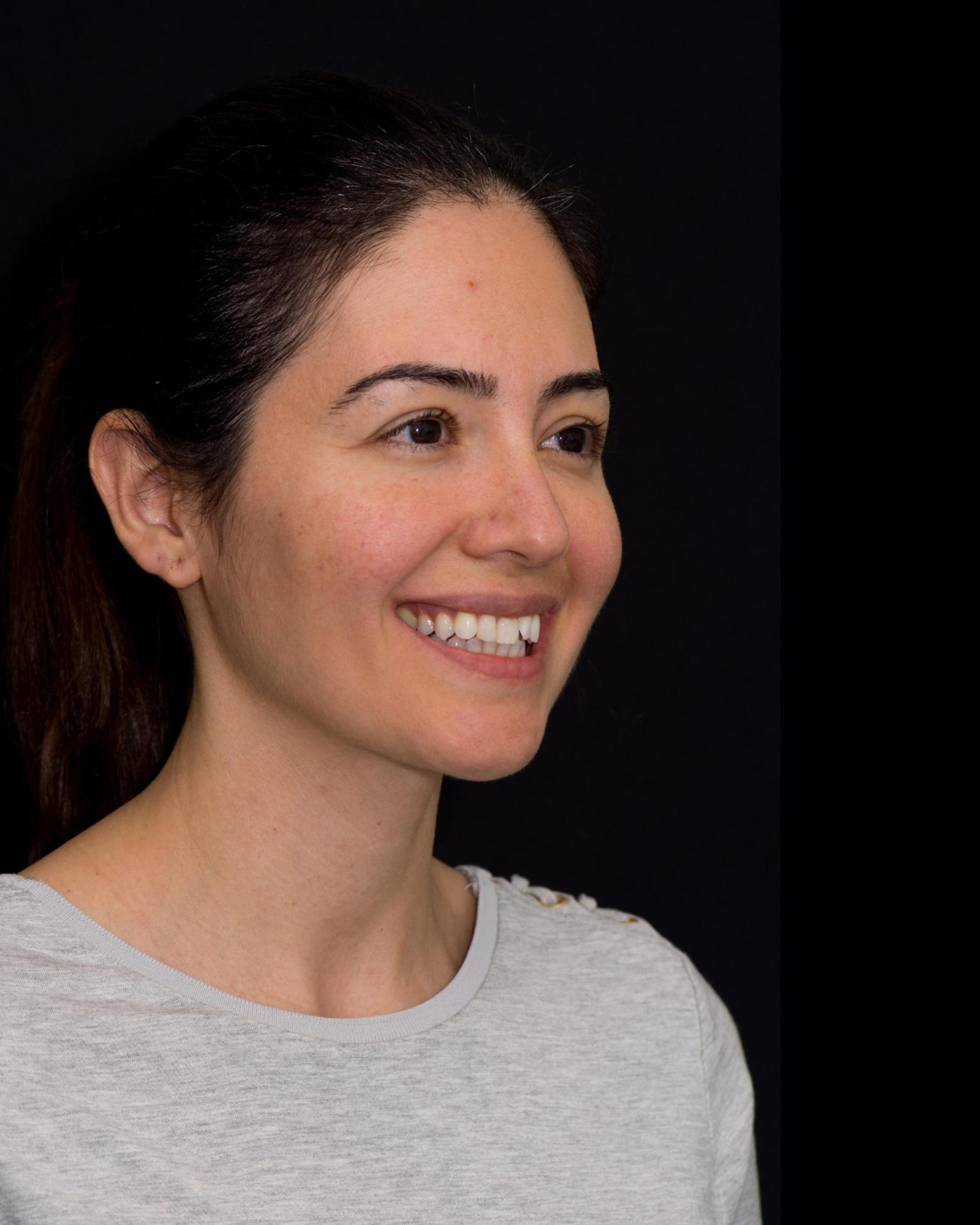 Before — Left Profile