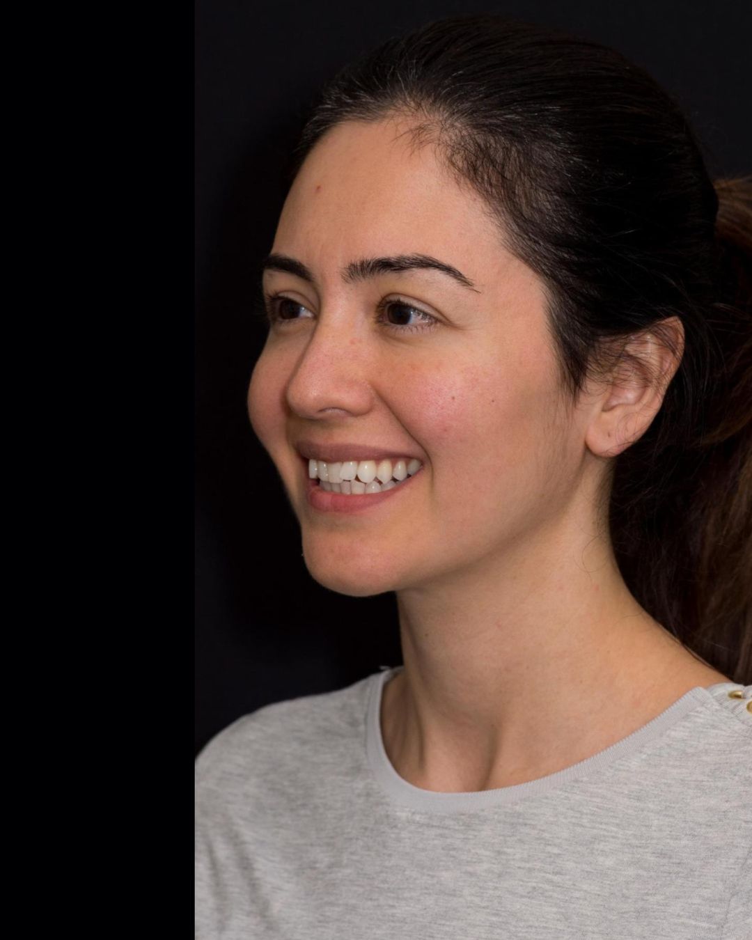 Before — Right Profile