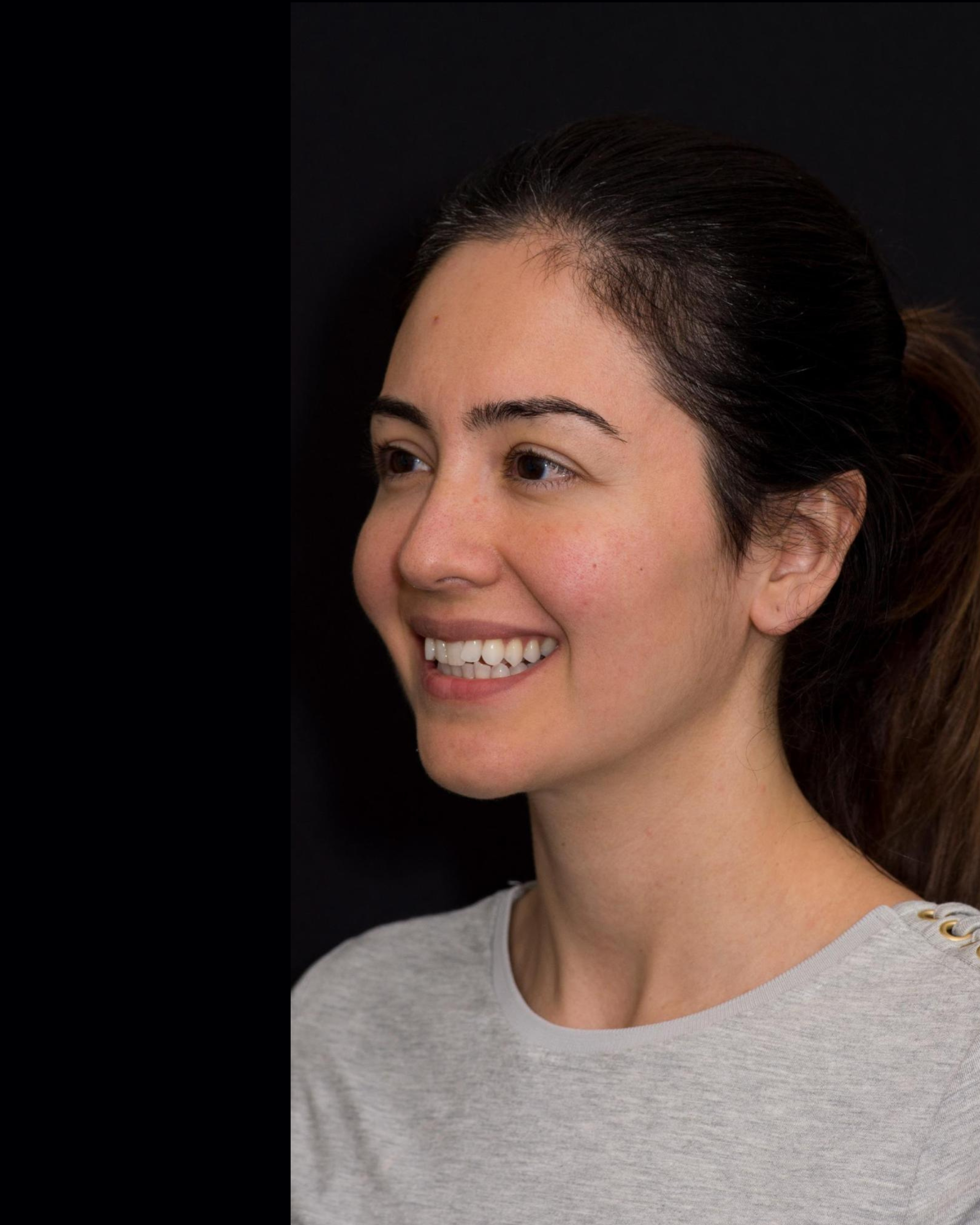 Before — Right Profile