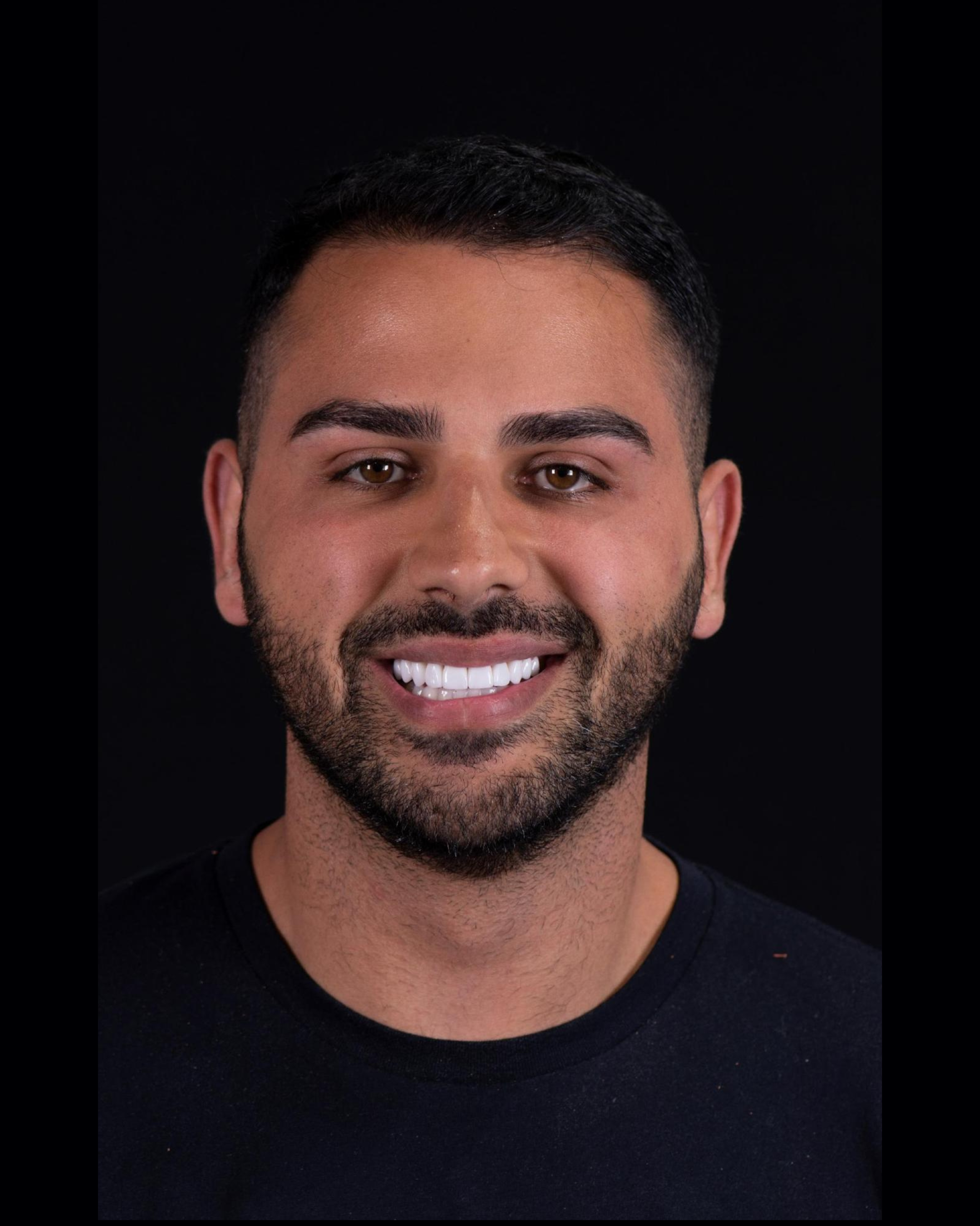 After — Front View